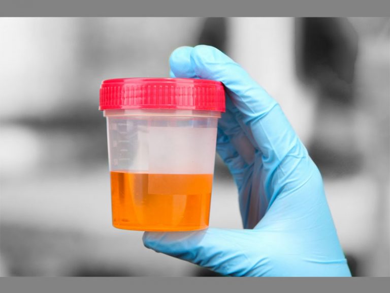 علت ادرار نارنجی