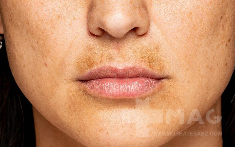 علت لک ملاسما