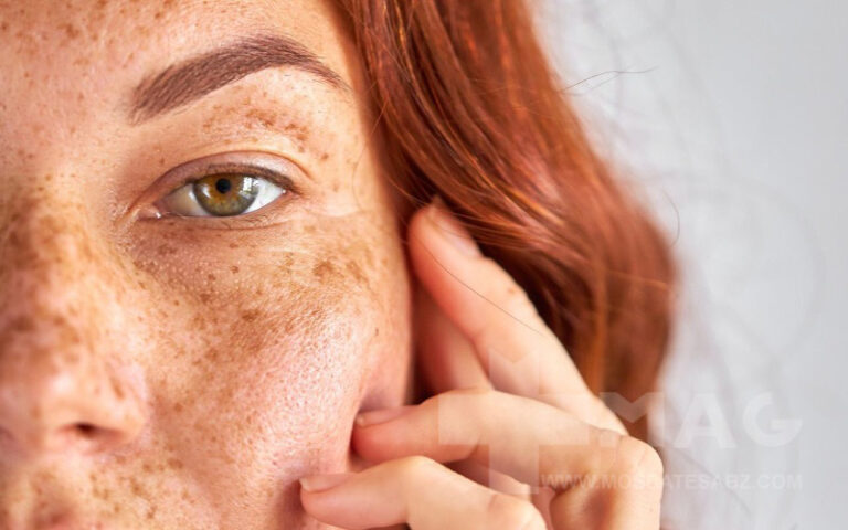 لک ملاسما چیست