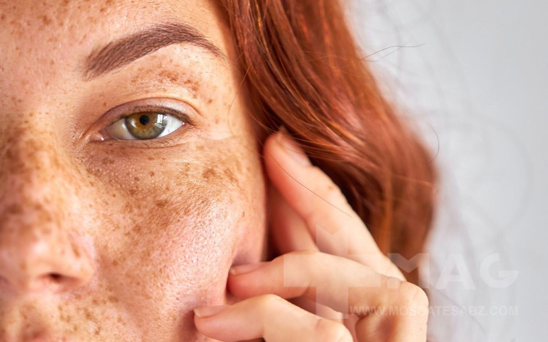 لک ملاسما چیست