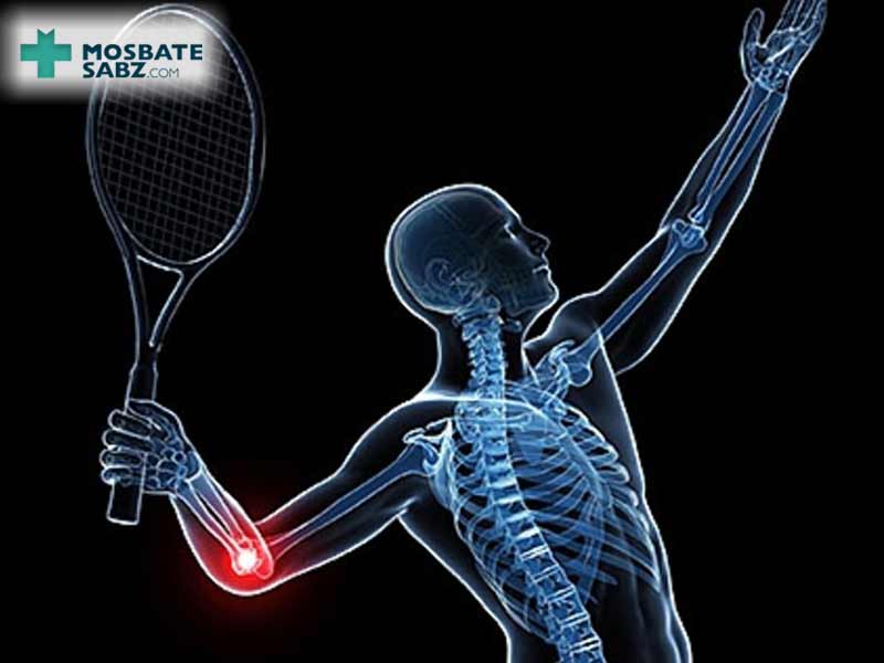 همه چیز درباره بیماری آرنج تنیس بازان