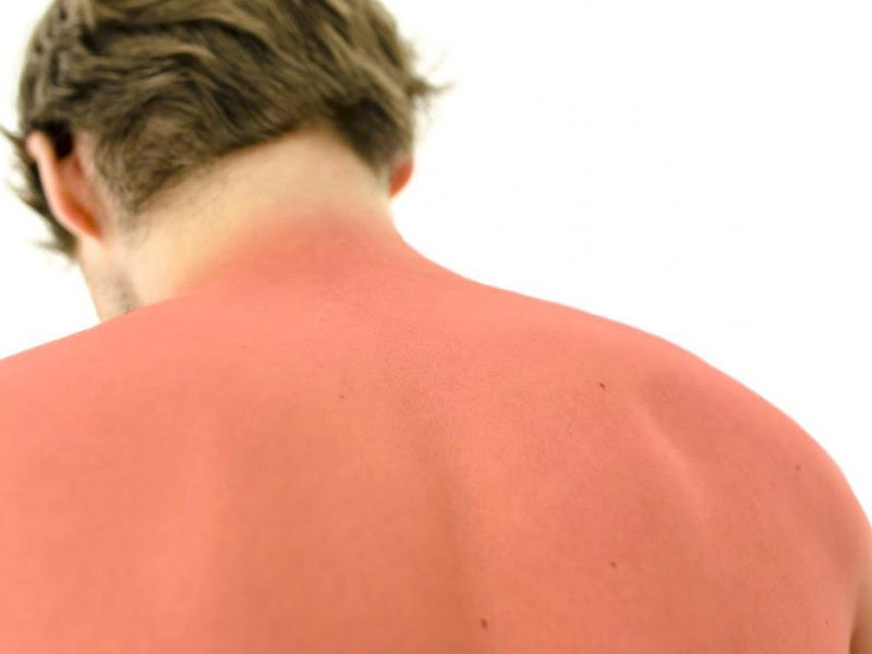 کرم آلدارا درمان کننده آفتاب سوختگی