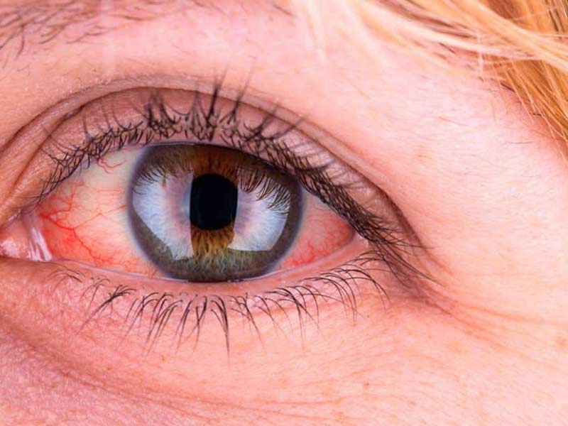 فشار چشم به چه دلایل ایجاد می شود؟