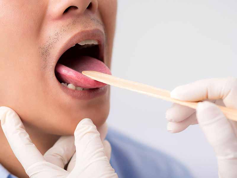سرطان زبان کشنده است؟