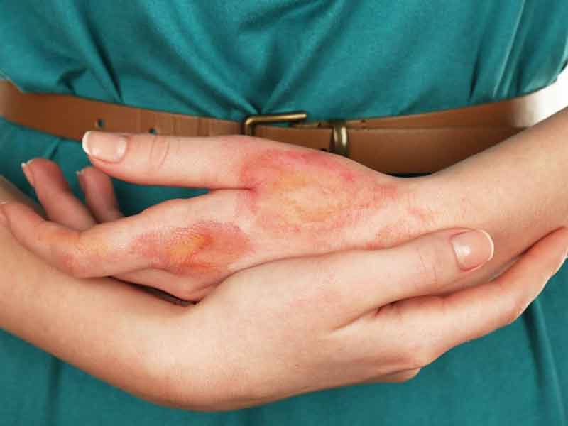 همه چیز در مورد بیماری اسکلرودرمی