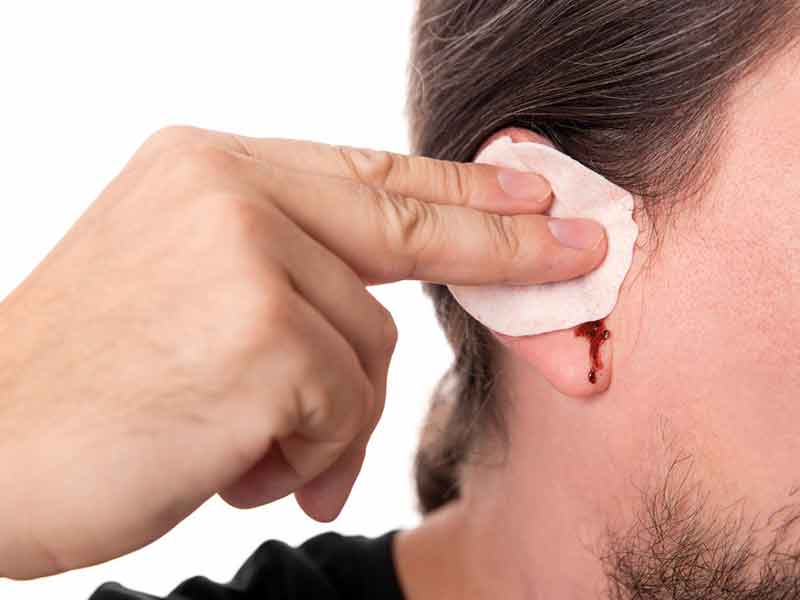 علائم پارگی پرده گوش چیست؟