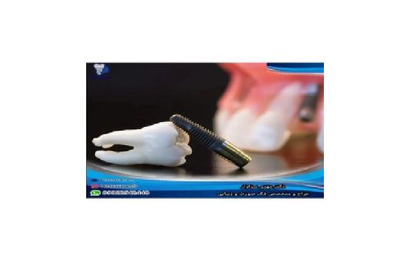 قیمت ایمپلنت دندان