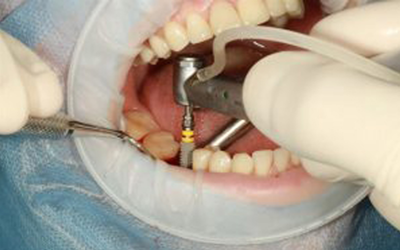 ایمپلنت دندان: مزایا، معایب، مراحل و قیمت ایمپلنت دندان