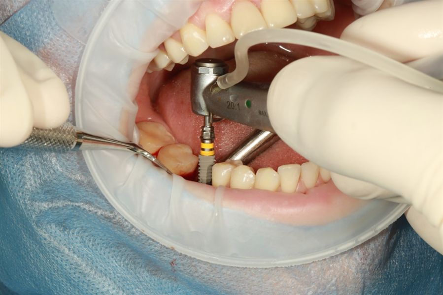 ایمپلنت دندان: مزایا، معایب، مراحل و قیمت ایمپلنت دندان