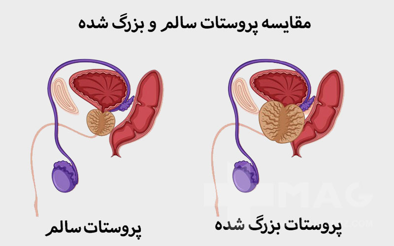 راه های پیشگیری از پروستات چیست؟