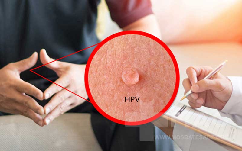 HPV یا زگیل تناسلی چیست؟
