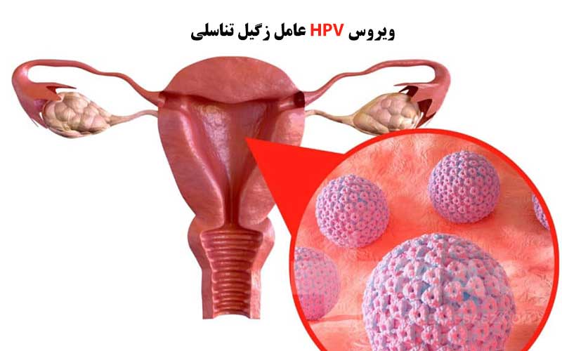 علت بازگشت زگیل تناسلی بعد از درمان؟