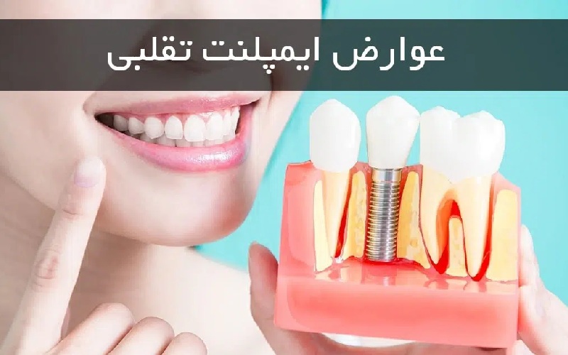 عوارض ایمپلنت تقلبی