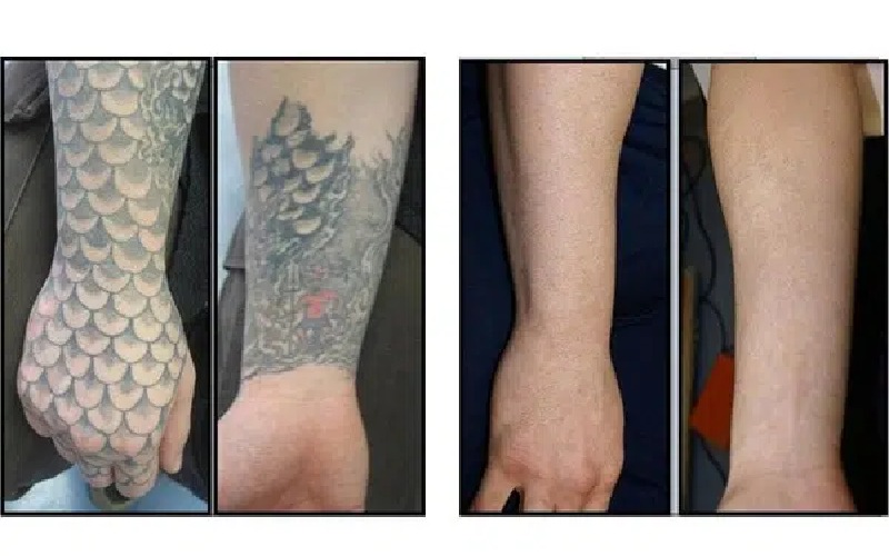 بهترین لیزر برای از بین بردن تاتو