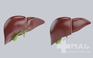 داروی گیاهی سنگ شکن صفرا