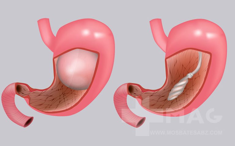بالن معده چیست