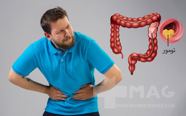 علائم سرطان روده