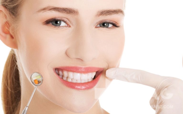 لمینت دندان