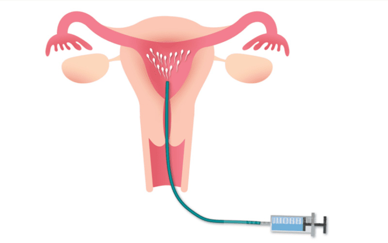 روش IVF تعیین جنسیت