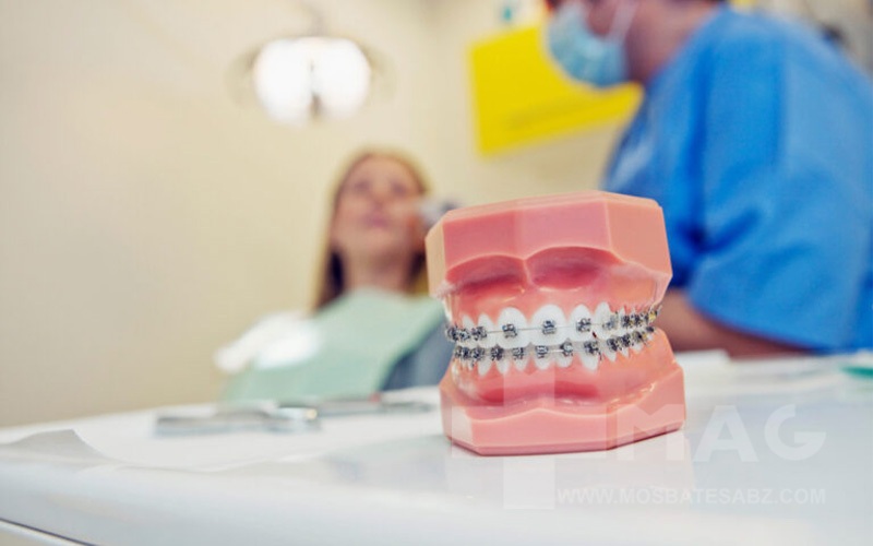 مراقبت های لازم بعد از دندان ارتودنسی