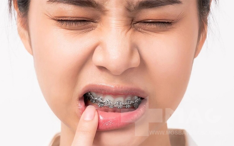 درد بعد از سیم کشی دندان