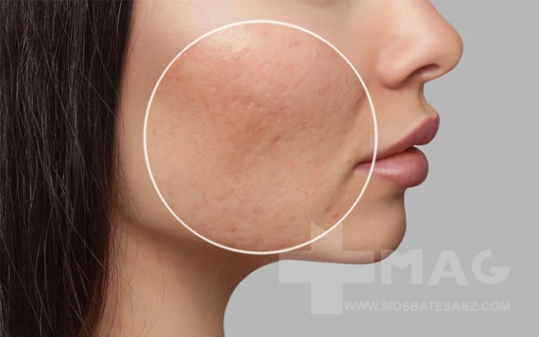 پماد برای از بین بردن جای جوش