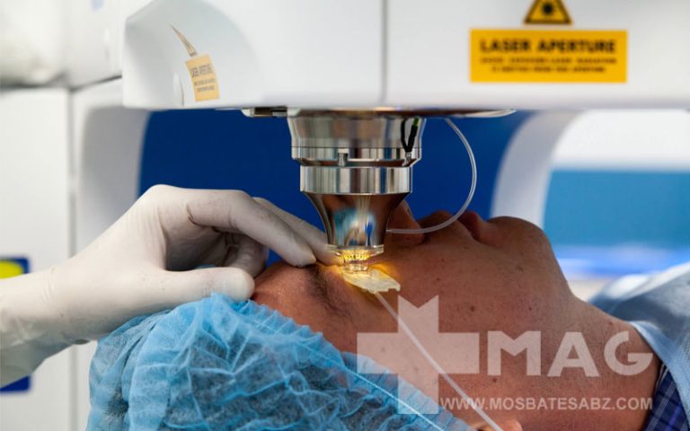 معرفی عمل لیزیک چشم