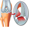 علت زانو درد ناگهانی - پارگی رباط