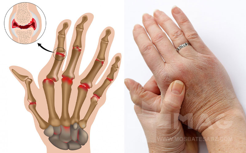 روماتیسم مفصلی چیست و چه علائمی دارد؟