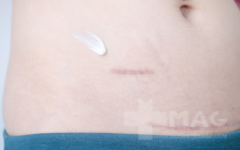 بهترین ترمیم کننده جای بخیه