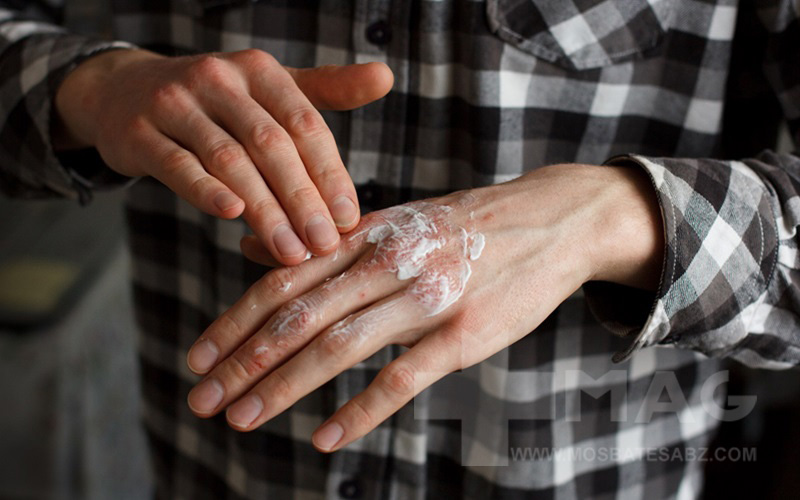 درمان پسوریازیس