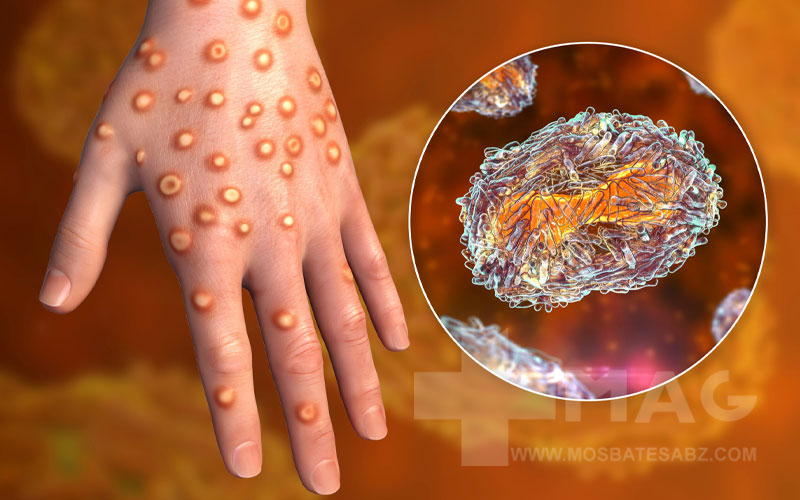 راه های تشخیص و درمان آبله میمونی