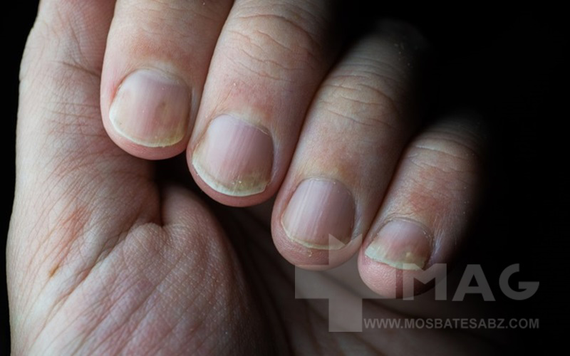 پسوریازیس ناخن