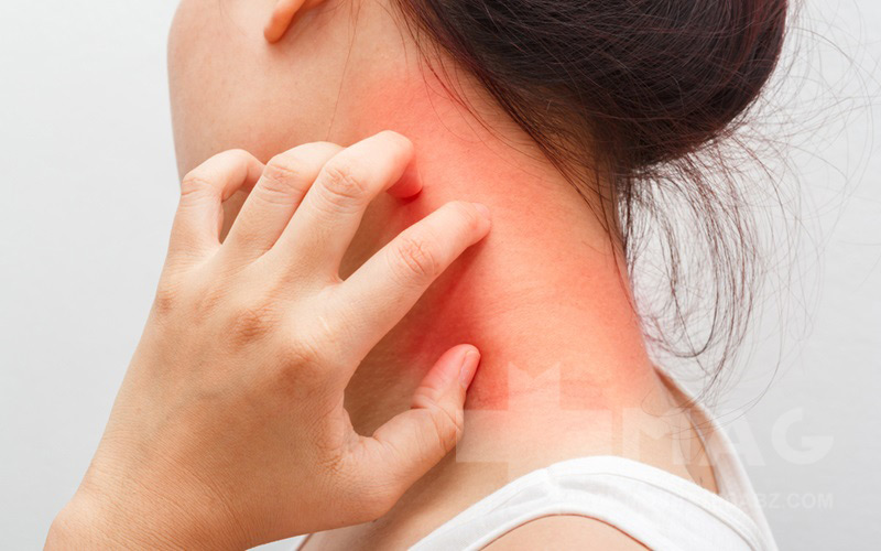 اگزما پوستی