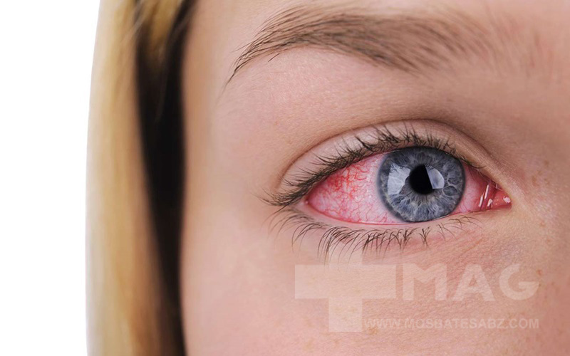 درمان قرمزی چشم