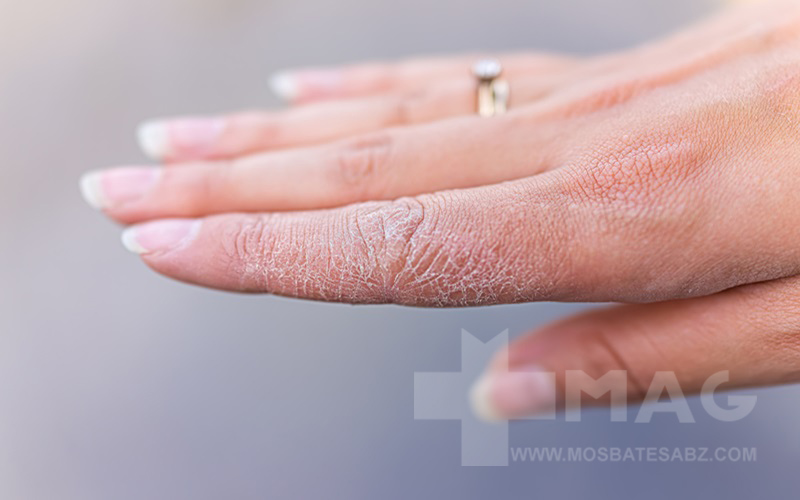 اگزما دست