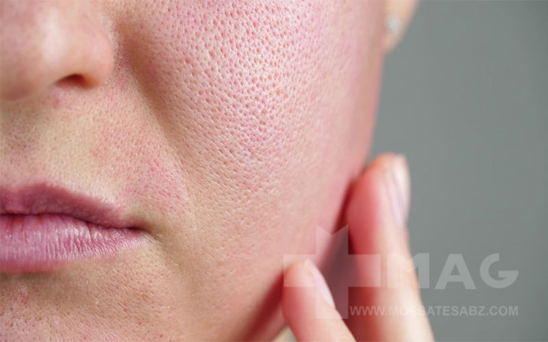 برای منافذ باز پوست چی خوبه