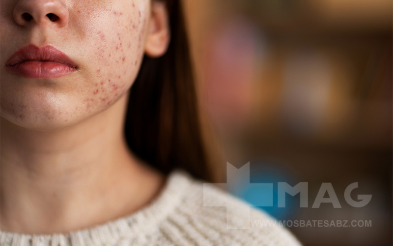 جوش هورمونی