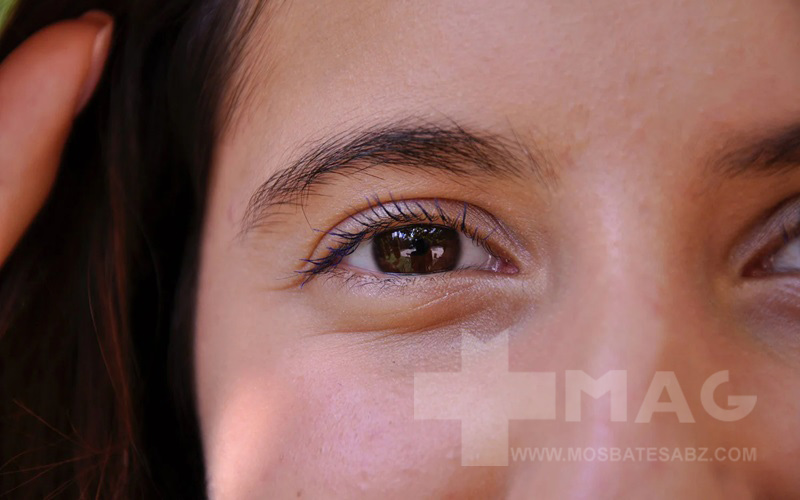 درمان پف زیر چشم