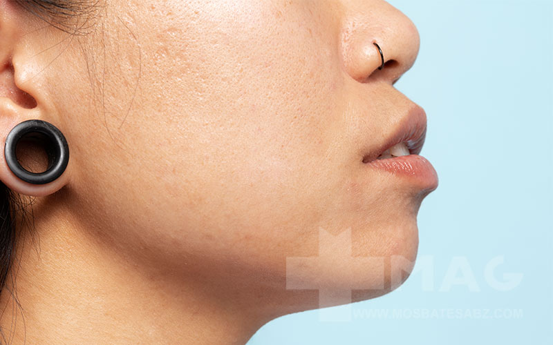 درمان قطعی منافذ باز پوست صورت خانگی