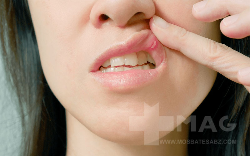 فرق آفت و سرطان دهان