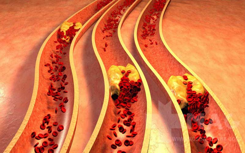 چربی خون بالا