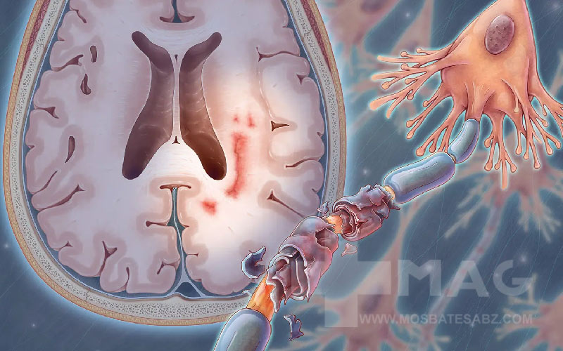 علت بوجود آمدن بیماری ام اس