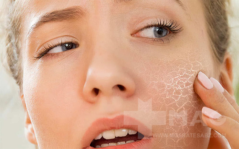 علت خشکی پوست