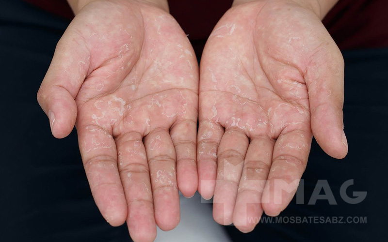 علت پوست پوست شدن کف دست