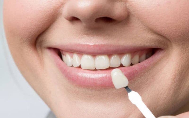 عوامل مؤثر بر طول عمر لمینت دندان چیست