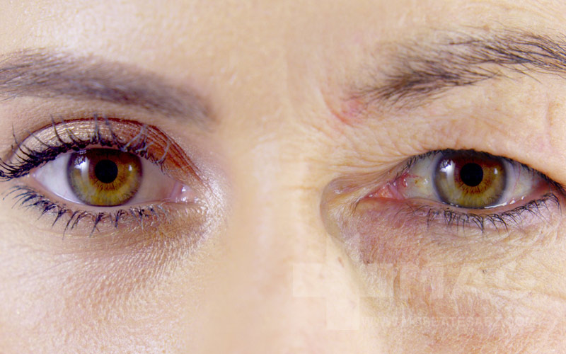 افتادگی پلک