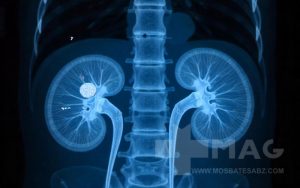 علت سنگ کلیه چیست؟ برای اطلاع از محل سنگ کلیه در بدن از تصویر برداری رادیولوژی استفاده می شود