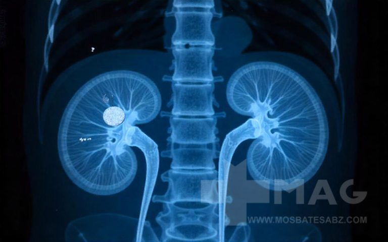 علت سنگ کلیه چیست؟ برای اطلاع از محل سنگ کلیه در بدن از تصویر برداری رادیولوژی استفاده می شود