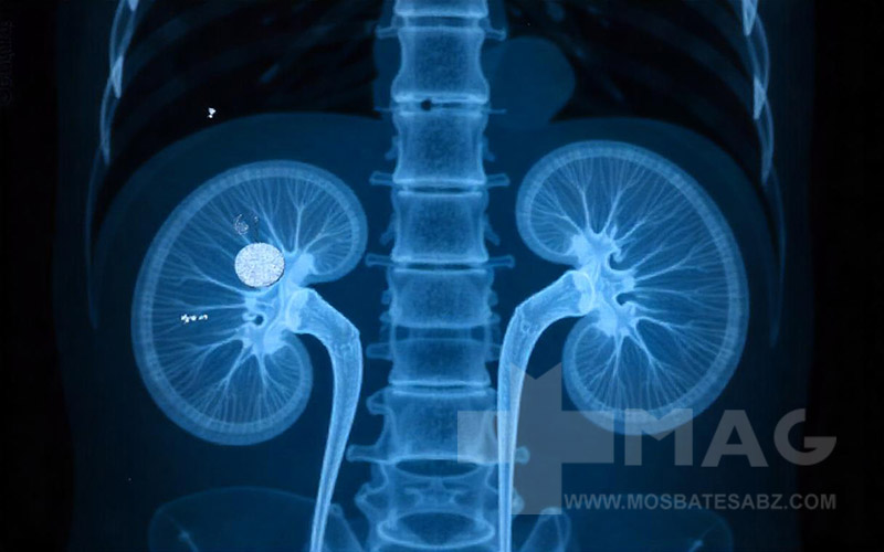 علت سنگ کلیه چیست؟ برای اطلاع از محل سنگ کلیه در بدن از تصویر برداری رادیولوژی استفاده می شود